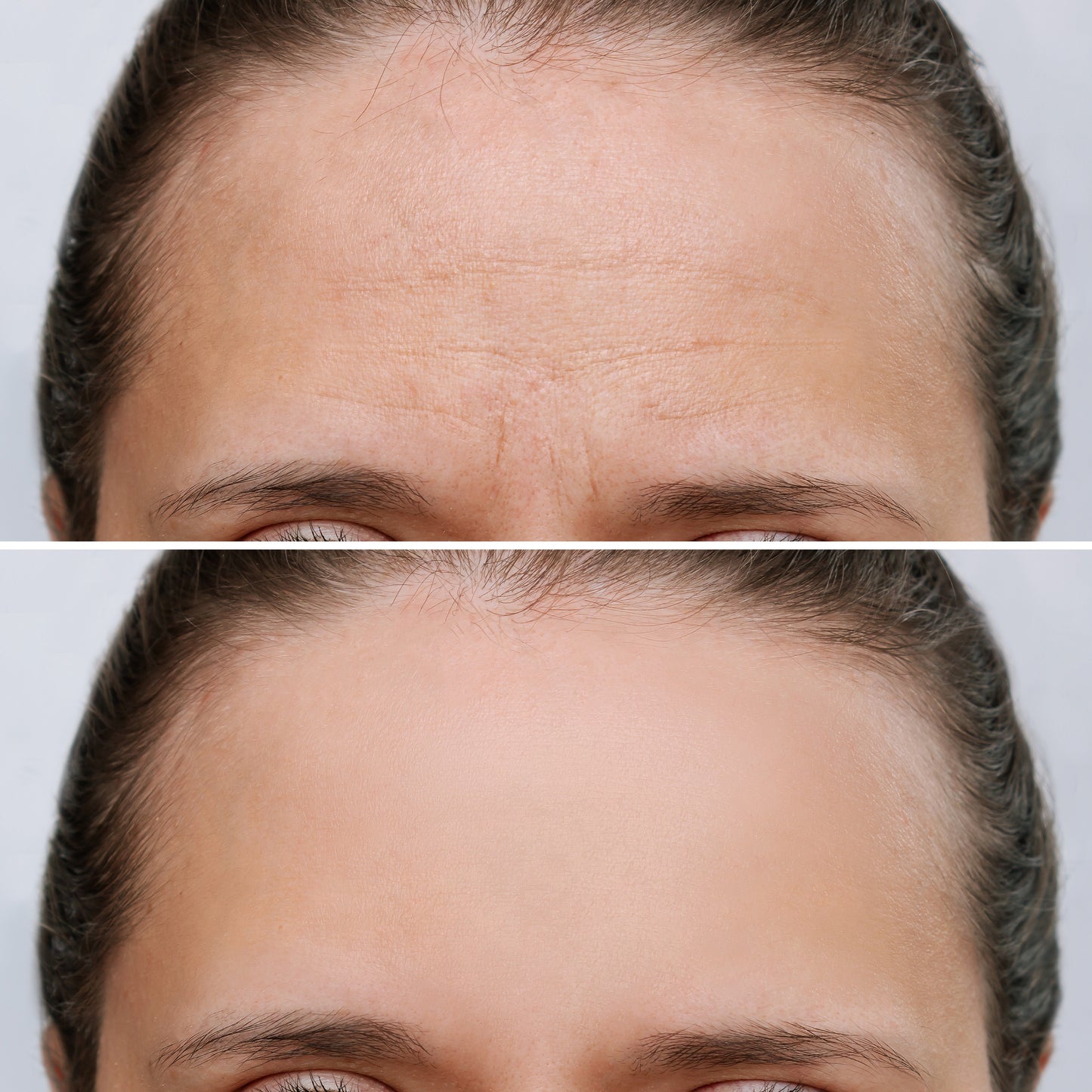 Microneedling Face